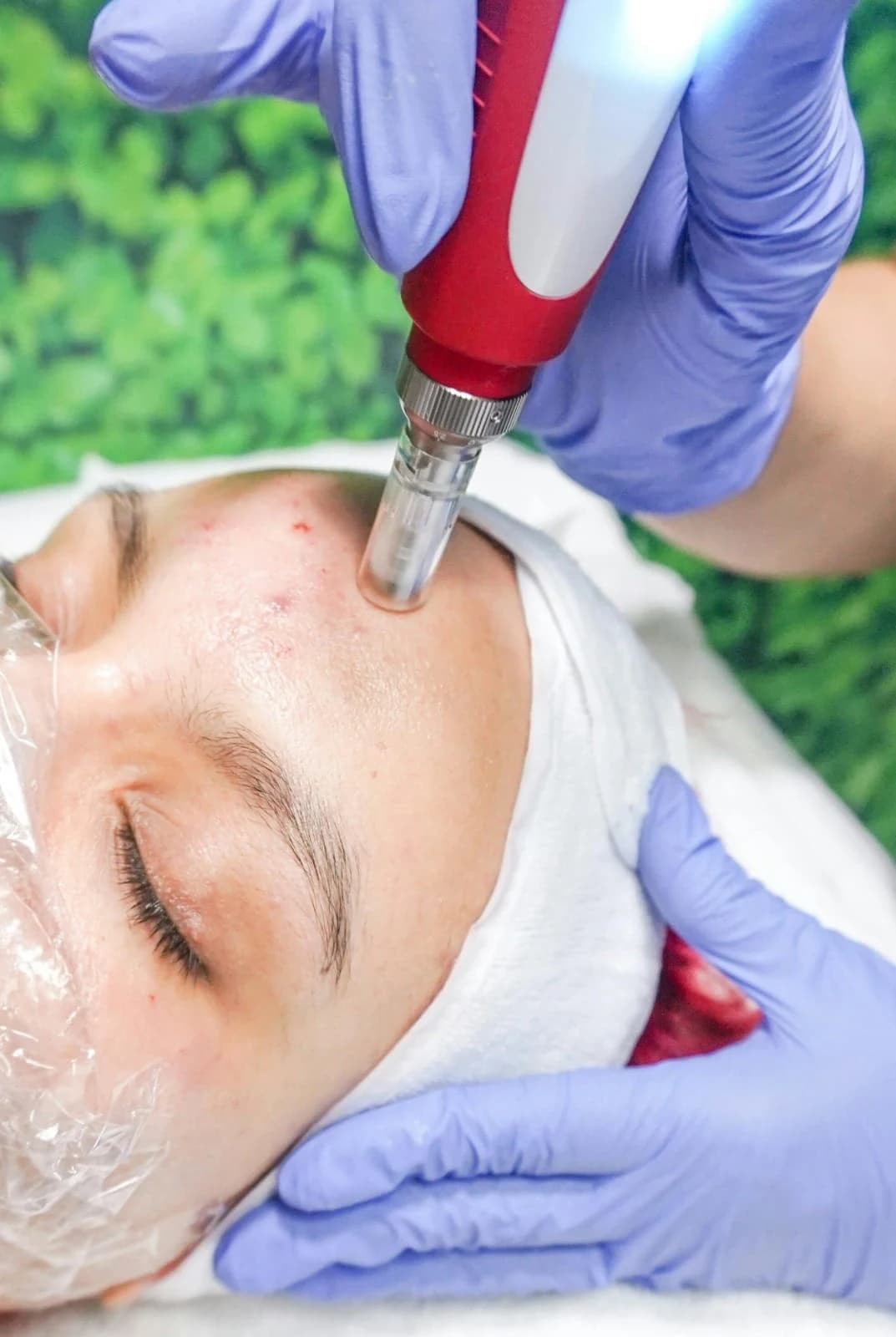 Microdermabrasion device and dermaplaning tools at Vedara Care aesthetic clinic