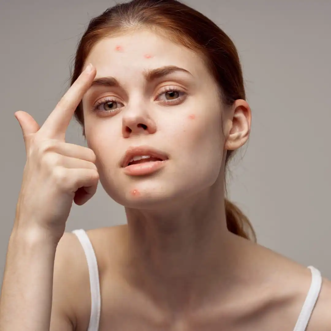 Acne treatment consultation at Vedara Care JVC Dubai with consultant dermatologist