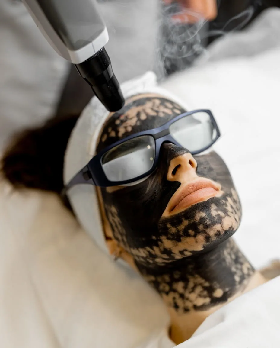 Carbon Laser Peel