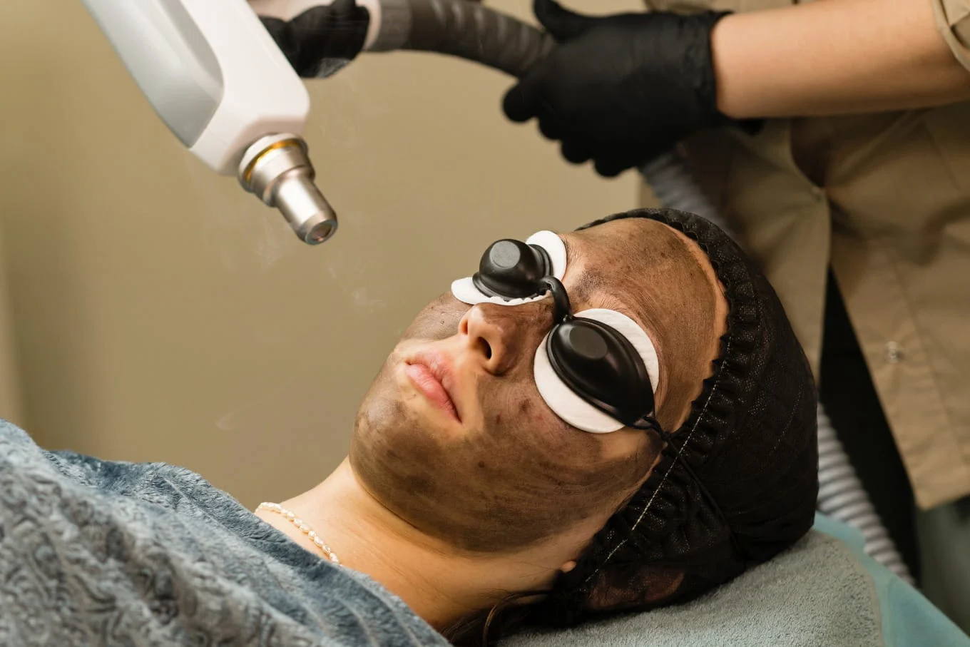 Carbon Laser Peel JVC