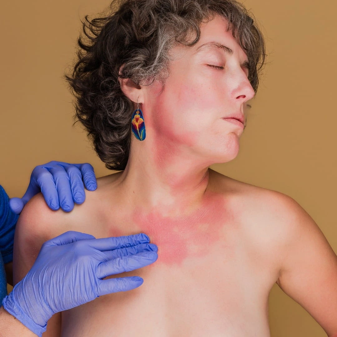 Eczema skin barrier dysfunction and inflammation illustration