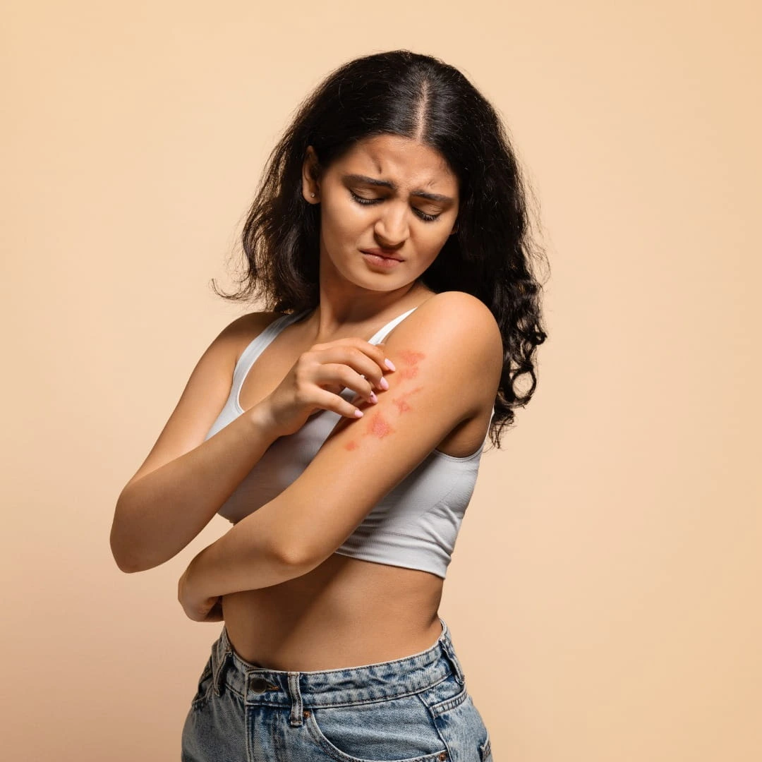 Eczema treatment consultation at Vedara Care JVC Dubai with consultant dermatologist