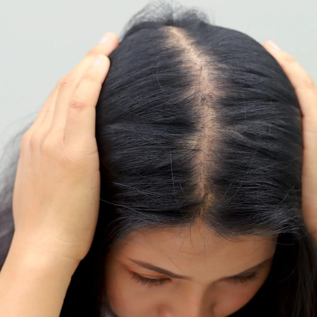 Hair loss treatment consultation at Vedara Care JVC Dubai with consultant dermatologist