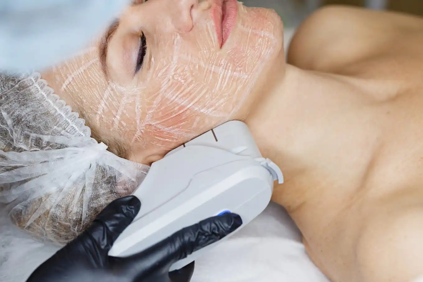HIFU Skin Lifting JVC