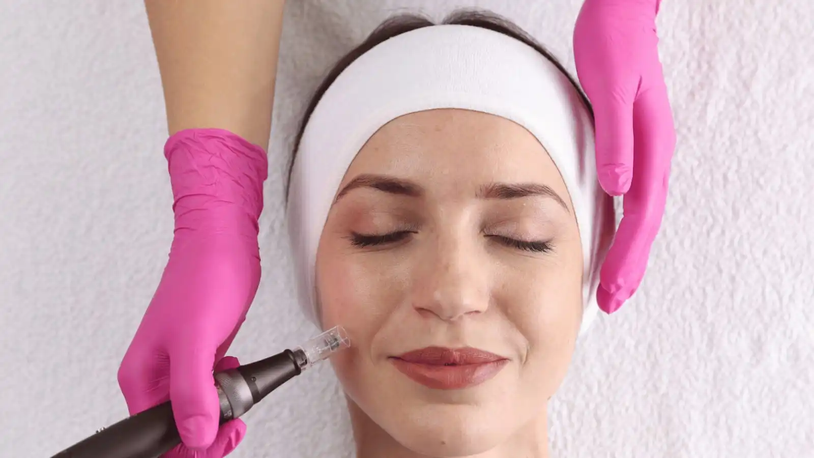 Microneedling JVC