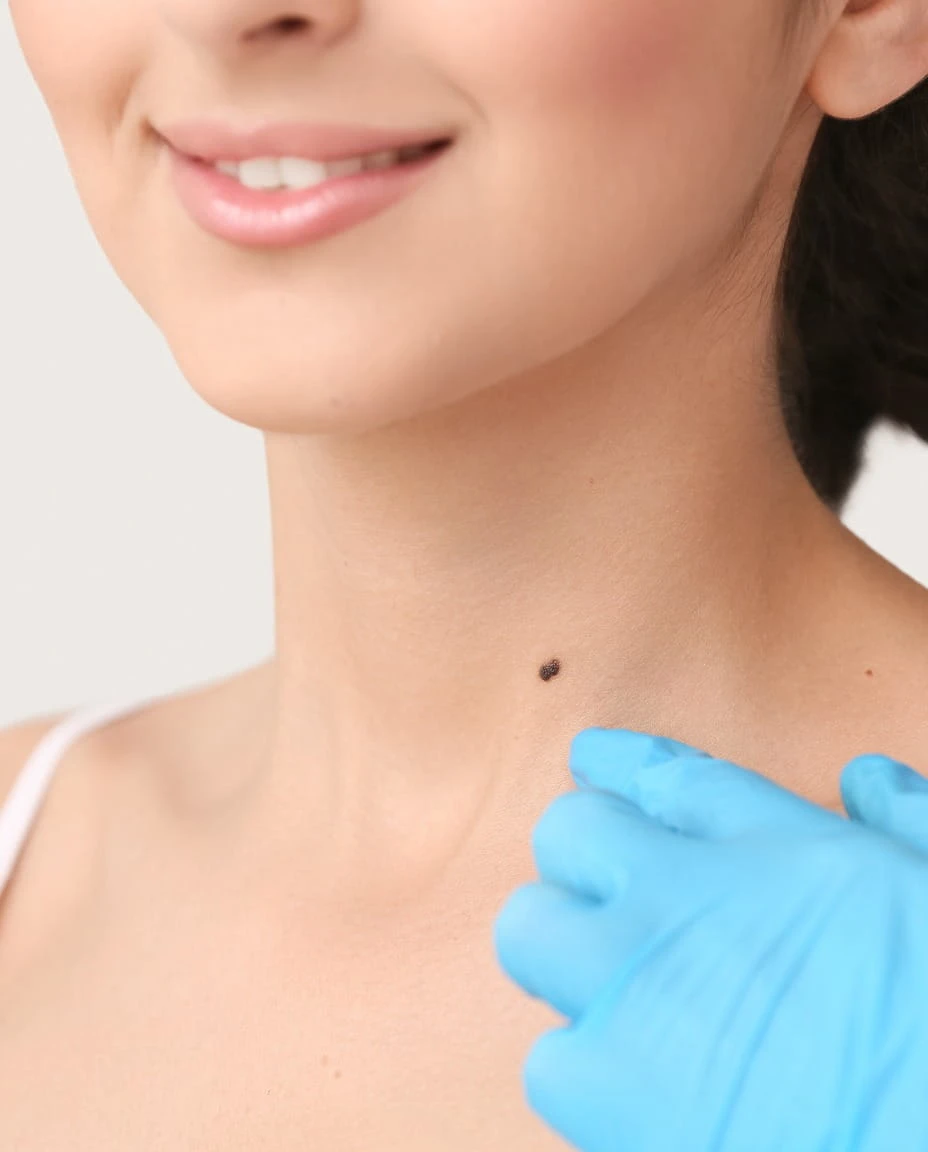 Mole removal in JVC dermatologist assessment at Vedara Care