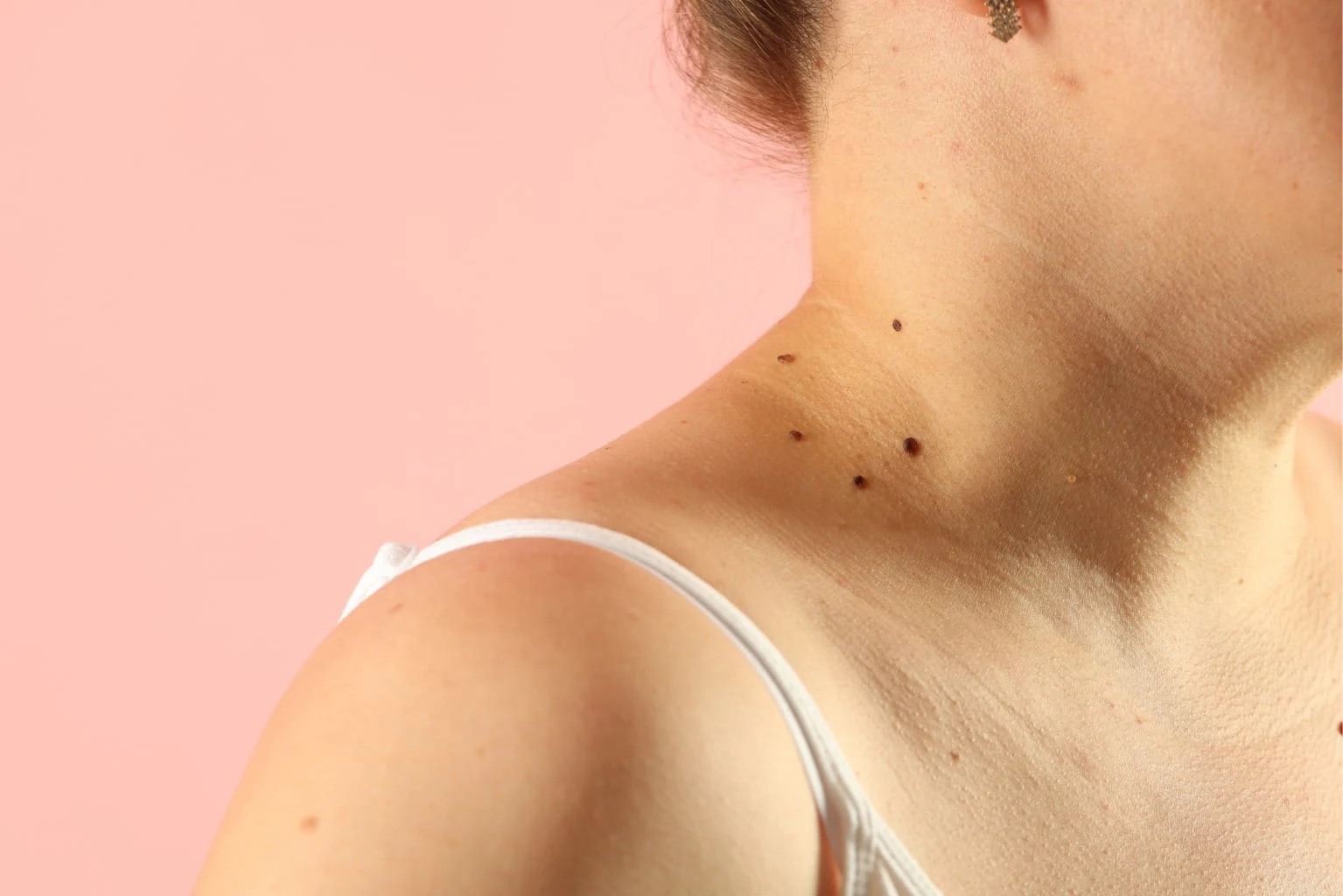 What mole removal feels like at Vedara Care JVC