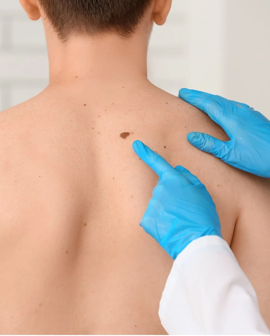 Mole removal preparation at Vedara Care JVC