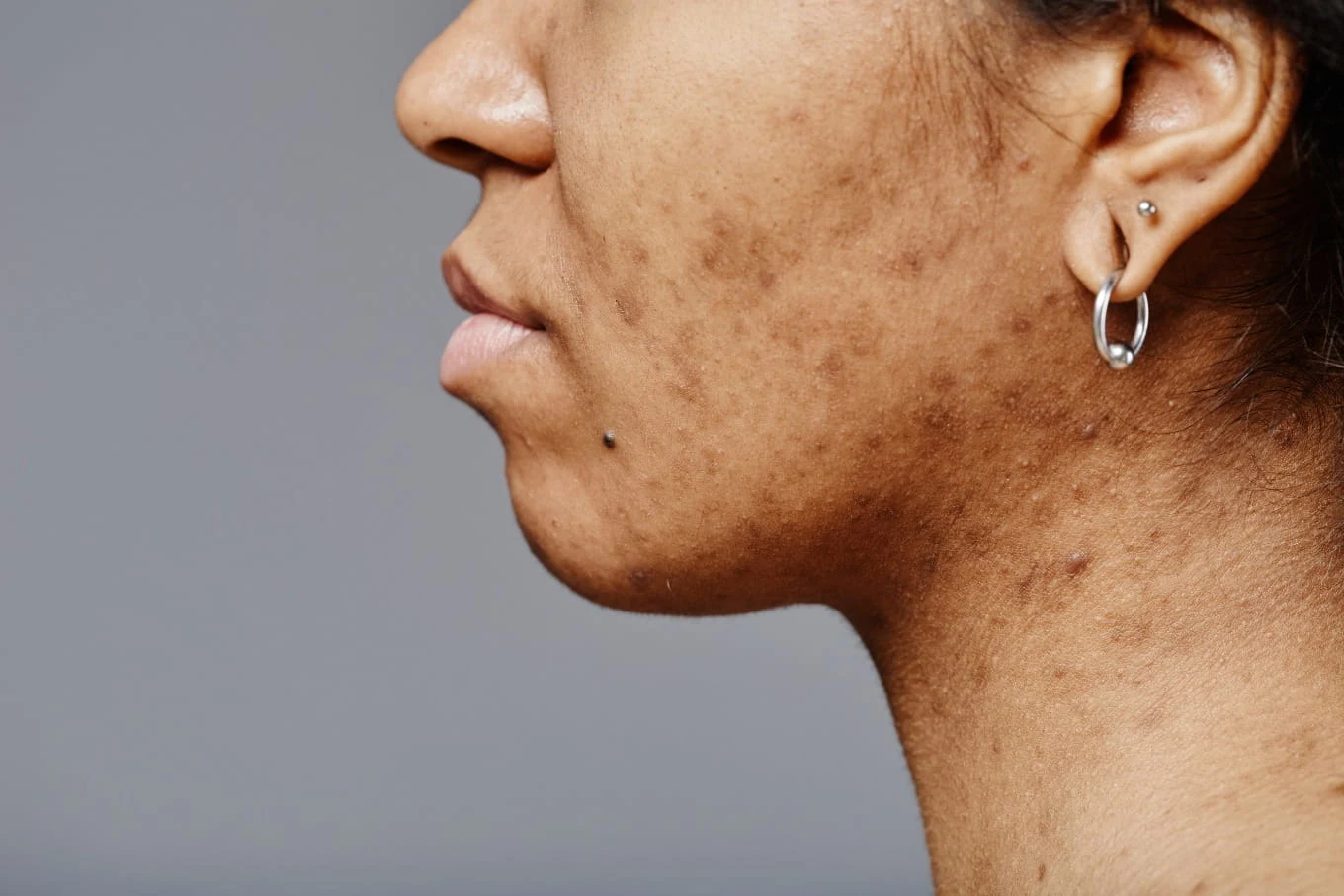 Pigmentation & Melasma Management JVC