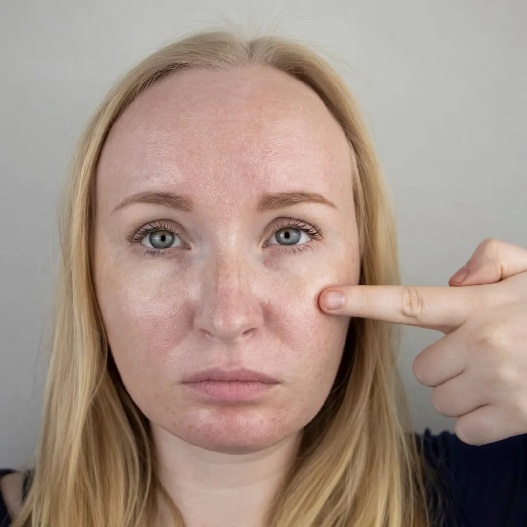 Pigmentation treatment consultation at Vedara Care JVC Dubai with consultant dermatologist