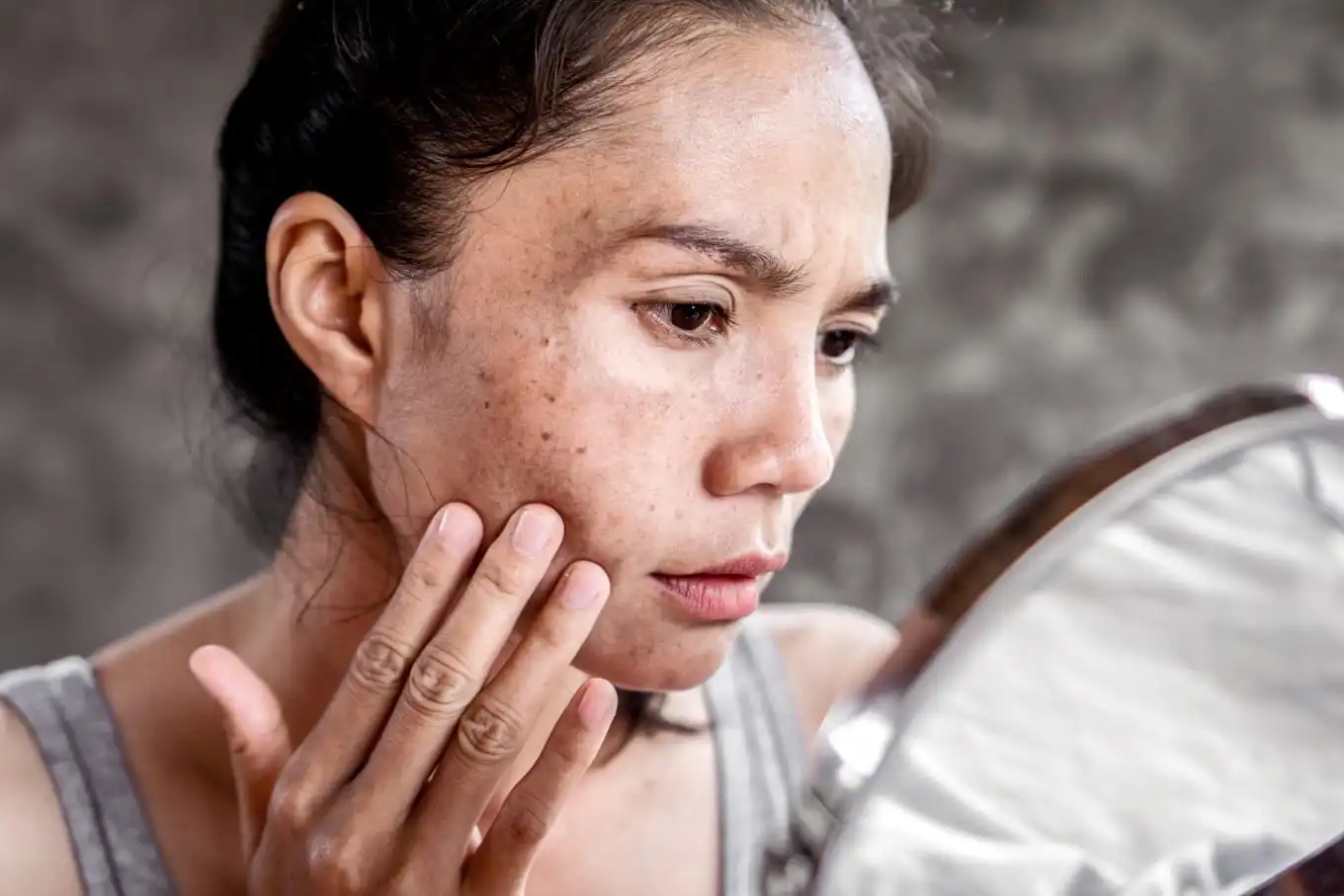 Pigmentation & Melasma Management JVC