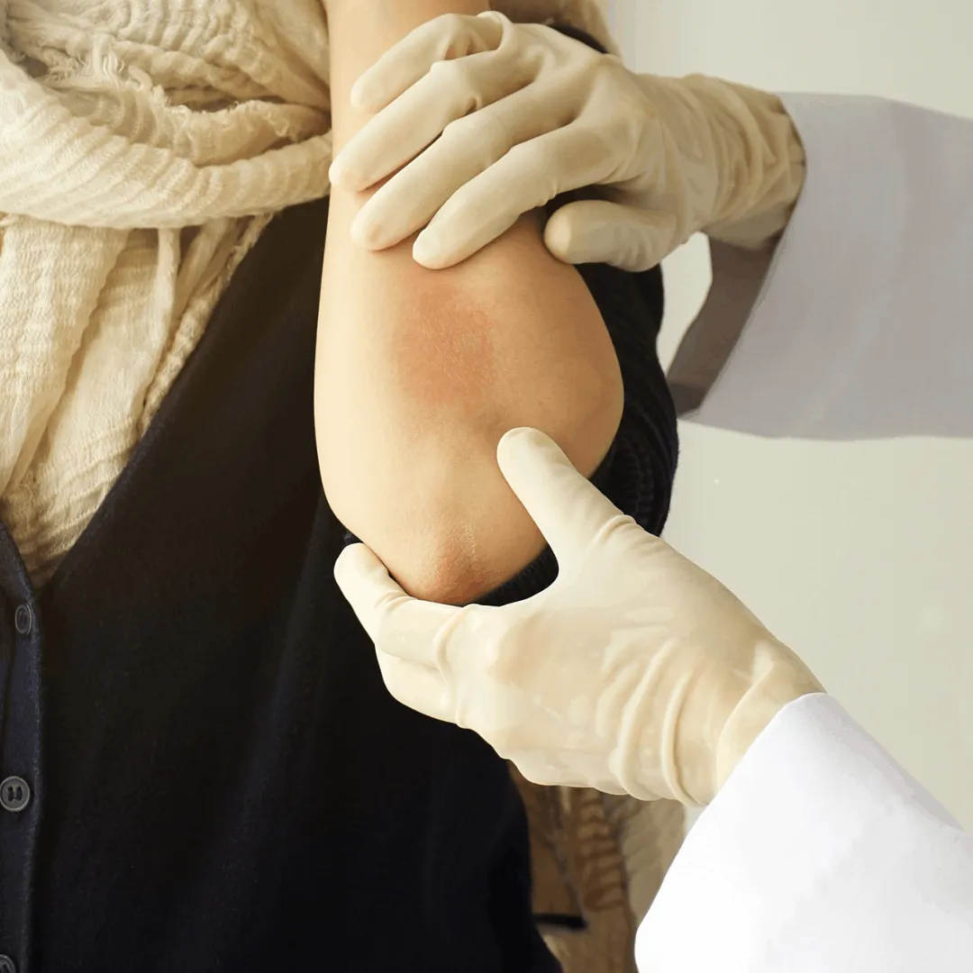 Psoriasis autoimmune inflammation IL-17 IL-23 pathway illustration