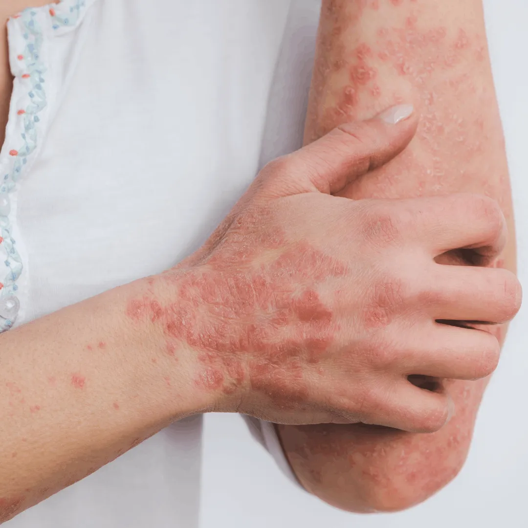 Psoriasis treatment consultation at Vedara Care JVC Dubai with consultant dermatologist
