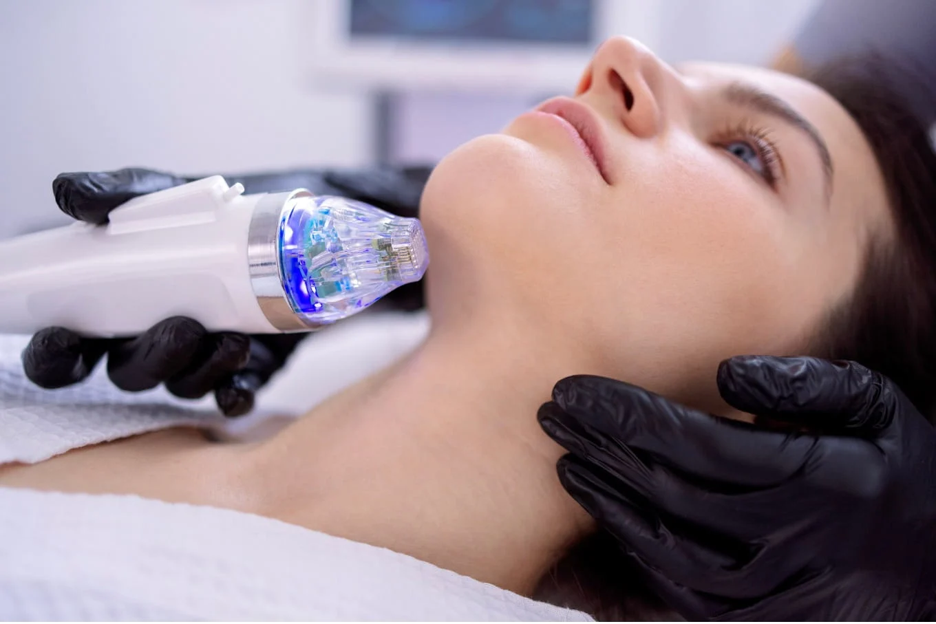 RF Microneedling JVC